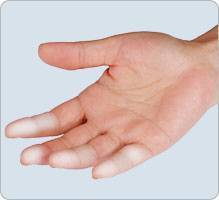 Maladie de Raynaud - syndrome des doigts blancs hiver froid extrémités de doigts blancs douleurs fourmillement blanc bleu rouge